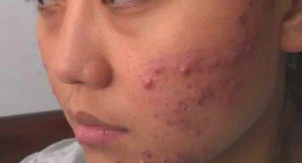 做E光祛痘手术注意事项是什么?