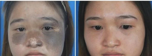 做光子治疗太田痣治疗效果怎么样？效果保持时间多久？