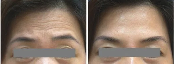 做去抬头纹失败修复多少钱