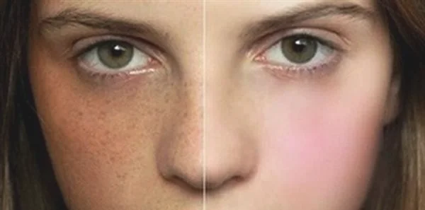 做去黄褐斑价格要多少