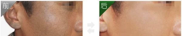 做E光治疗太田痣费用要多少