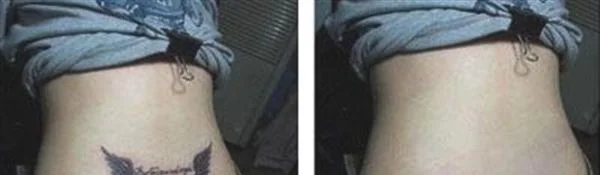 做皮肤磨削去纹身价格贵不贵