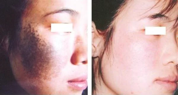 做激光去太田痣手术多少钱？