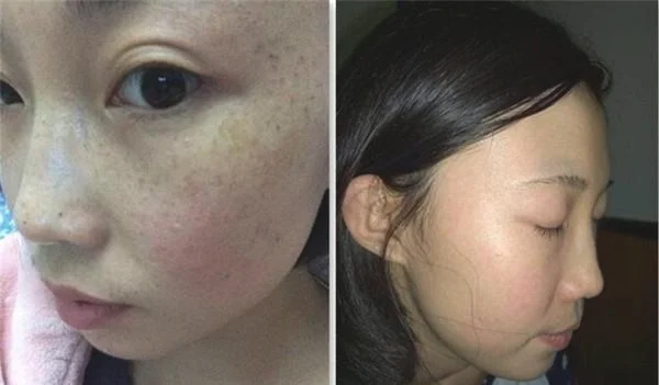 做化学剥脱祛斑价格是多少