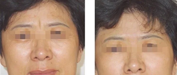 玻尿酸去眉间纹有副作用吗？