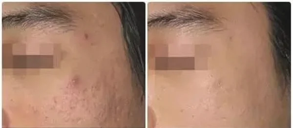 做激光去痘疤价格要多少