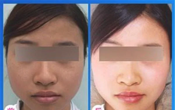 激光美白适合什么人？