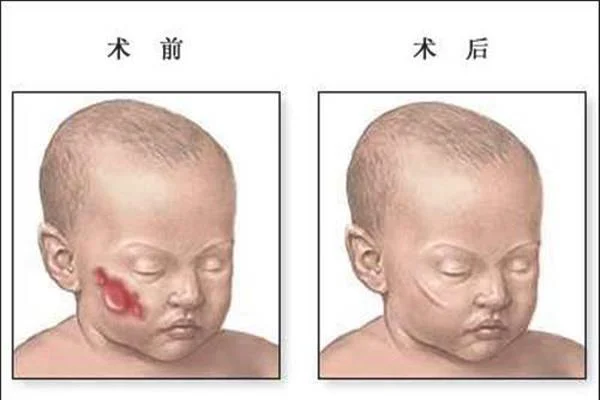 治疗血管瘤手术注意事项是什么？