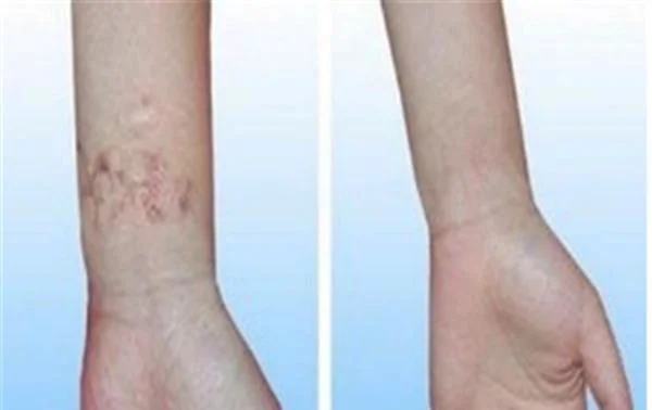 烧伤疤痕修复恢复需要注意什么?