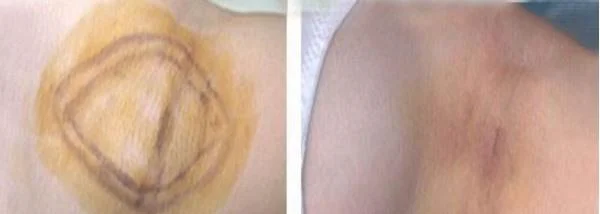 做激光去腋臭治疗效果怎么样？效果保持时间多久？