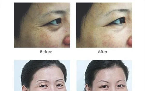 做自体脂肪去鱼尾纹多少钱