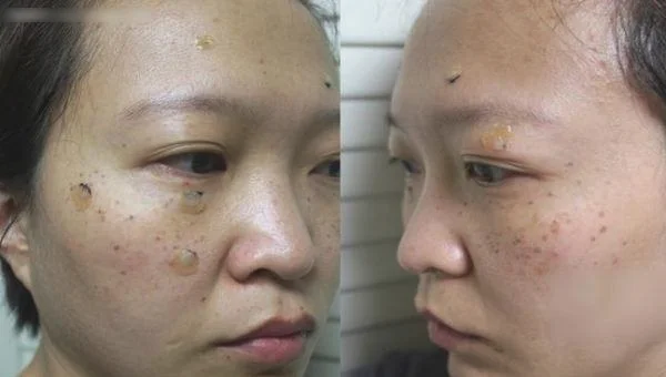 剥脱治疗去雀斑手术术后护理?