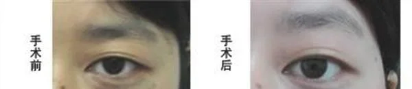 冷冻去除太田痣手术注意事项是什么？