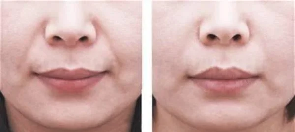 做胶原蛋白去法令纹价格贵不贵