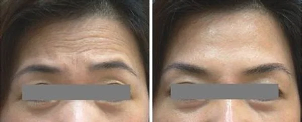 玻尿酸去抬头纹手术注意事项是什么?