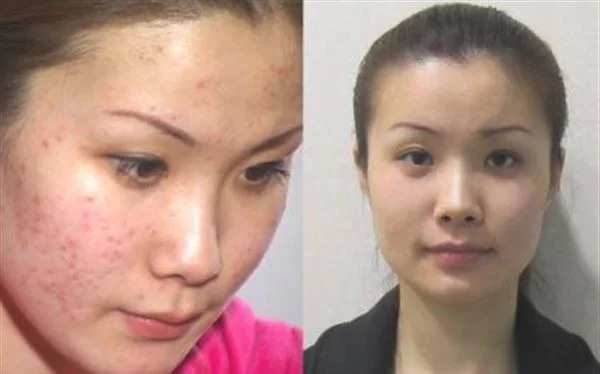 做E光去痘印多少钱