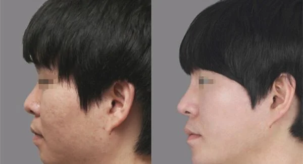 做切除缝合治疗痘疤手术注意事项是什么？