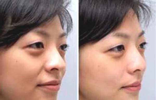 悬吊除皱去法令纹手术术后护理？