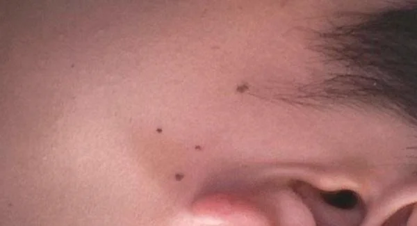 做微晶磨削点痣手术注意事项是什么？