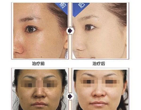 激光美白效果怎么样？