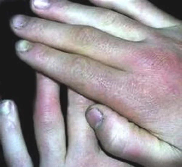 做冻疮疤痕修复手术多少钱？