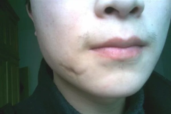 面部疤痕修复手术安全吗?