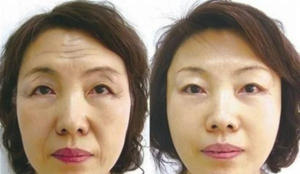 小切口除皱去抬头纹需要怎么护理？