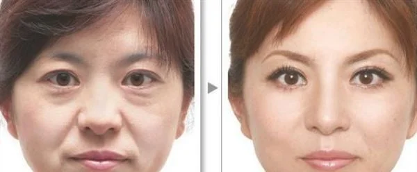 做脉冲光去鱼尾纹治疗效果怎么样?效果保持时间多久?