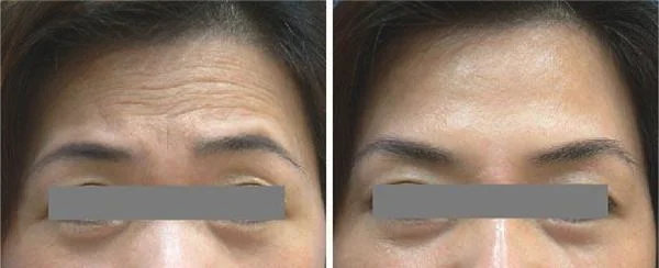 微晶磨削去抬头纹优点是什么？