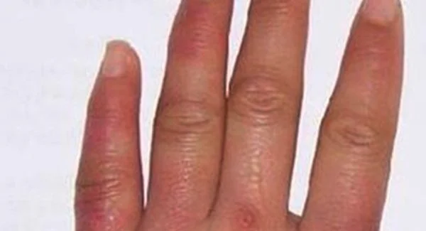 做冻疮疤痕修复手术注意事项是什么？