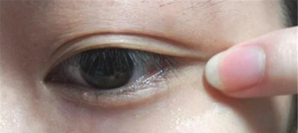 做脉冲光去眼角细纹价格多少钱