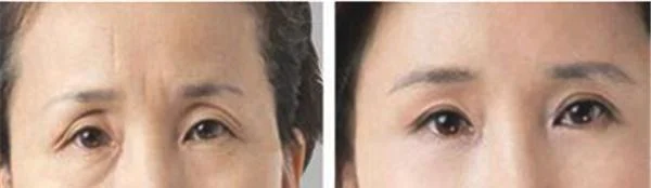 自体脂肪去眉间纹维持时间是多久？