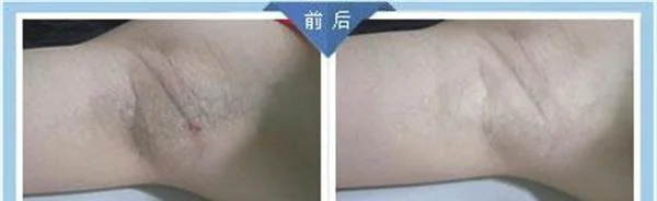 剥离去狐臭手术注意事项是什么?