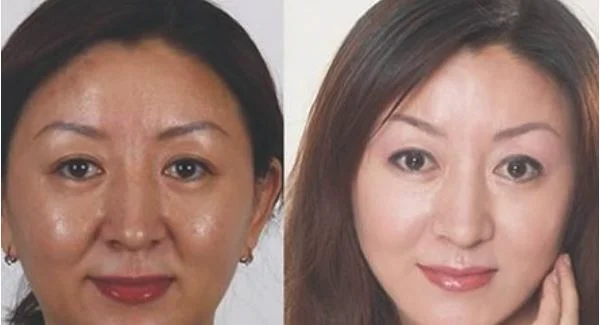 做悬吊除皱去法令纹治疗效果怎么样？效果保持时间多久？