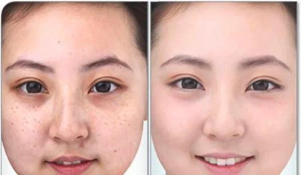 做祛斑手术多少钱？