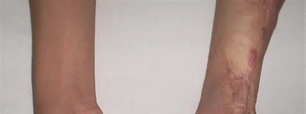 做烫伤疤痕修复价格贵不贵