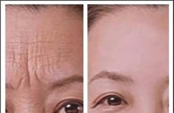 自体脂肪去抬头纹维持时间是多久？