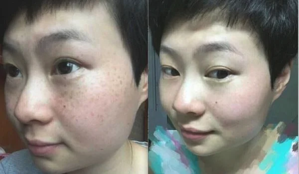 做剥脱治疗去雀斑价格