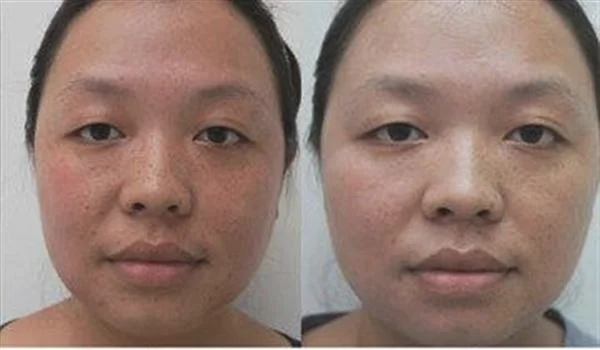 做激光去青春痘手术多少钱?