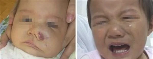 做光子治疗血管瘤多少钱