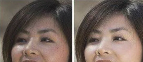 做冷冻治疗去痘疤价格多少钱