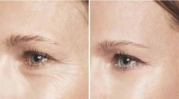 做激光除鱼尾纹费用大概需要多少