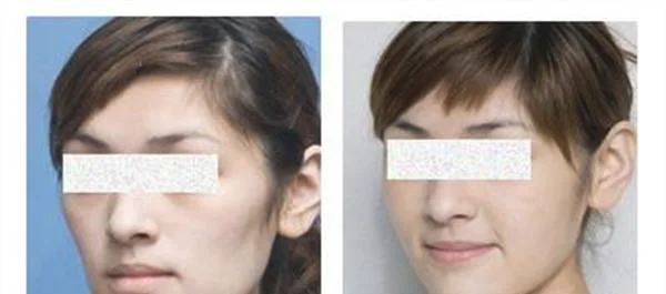 做爱贝芙去痘疤多少钱