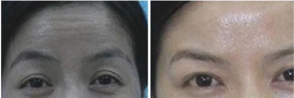 做胶原蛋白去抬头纹价格多少钱