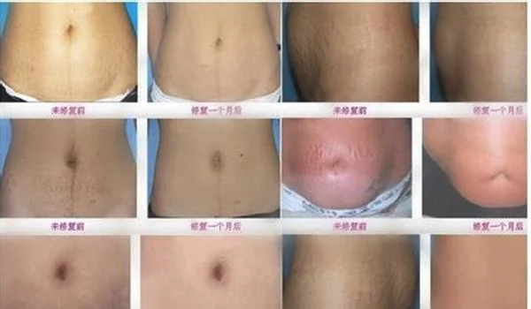 剖腹产疤痕修复多久能恢复?