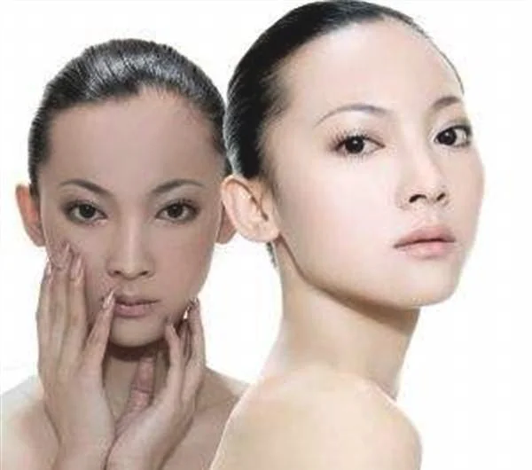 冷冻法去黄褐斑手术术后护理？