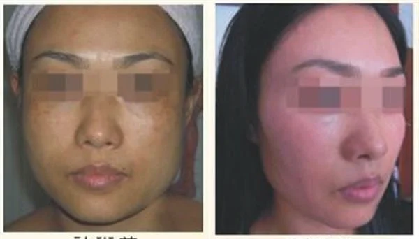 做光子去雀斑多少钱