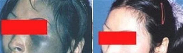 做去太田痣治疗效果怎么样？效果保持时间多久？