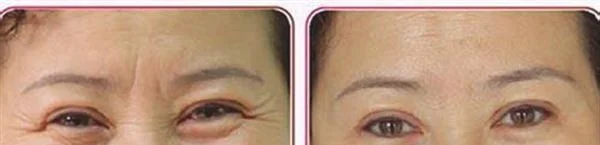 做微晶磨皮去眉间纹手术多少钱?