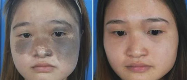 做冷冻去除太田痣治疗效果怎么样？效果保持时间多久？